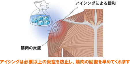 アイシングは必要以上の炎症を防止し、筋肉の回復を早めてくれます