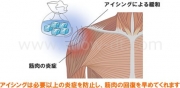 筋肉疲労にアイシング