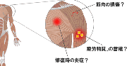 筋肉痛の原因とは？